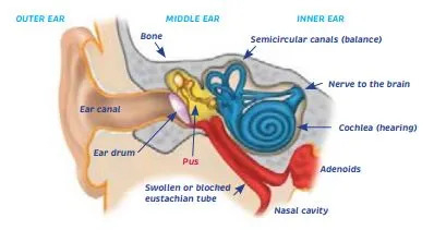 Ear infections, earache and glue ear - HE1414
