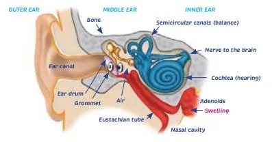 Ear infections, earache and glue ear - HE1414